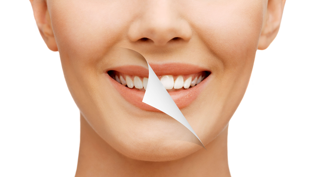 Enhance your confidence with dental smile makeover
